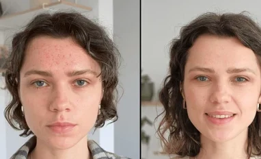 Mironeedling for acne, before and after results