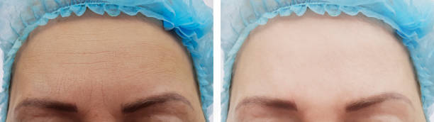 microneedling before and after for wrinkles