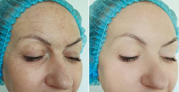 microneedling before and after results for scars